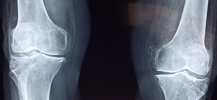 knee-2253047_1280